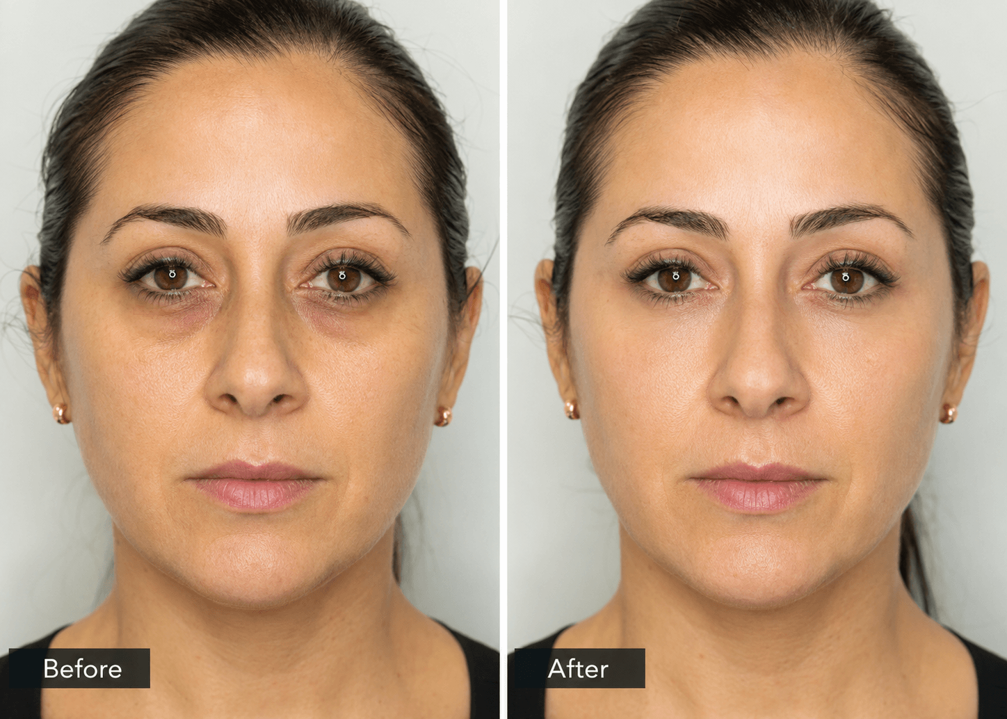 Roseville, CA, Undereye Treatm